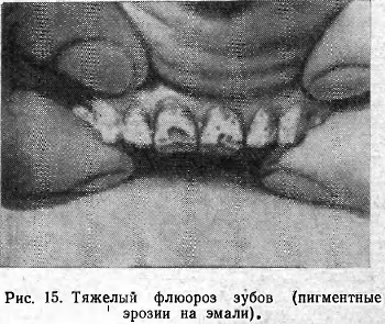 Тяжелый флюороз зубов (пигментные агностику.  1  эрозии на эмали)