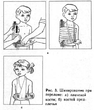 Шинирование при переломах