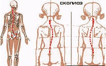 Сколиоз и его профилактика