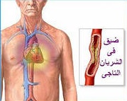 Как нужно изменить свою жизнь после инфаркта
