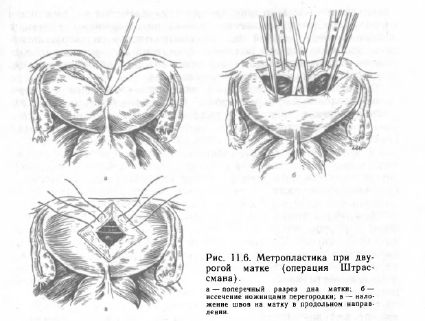 Метропластика при двурогой матке (операция Штрассмана)