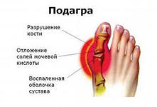 картинка подагры